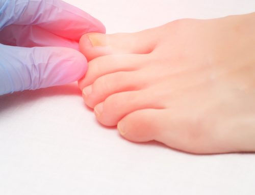 5 Myths About Ingrown Toenails